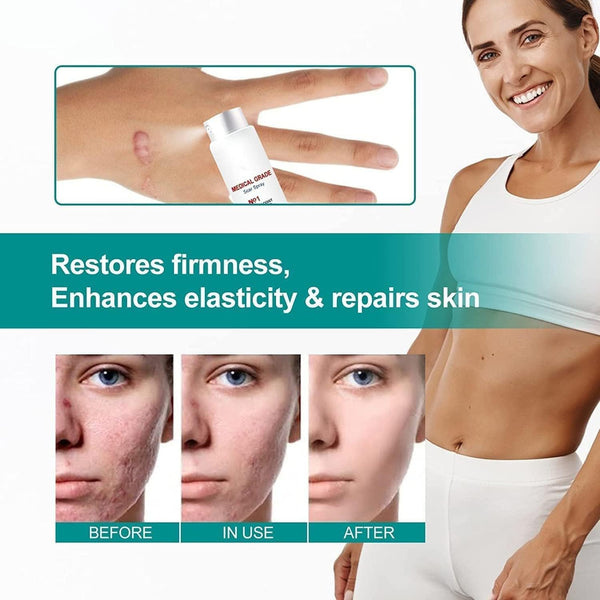 Medical Grade Scar Removal Spray – Advanced Acne Scar Treatment, 1pcs